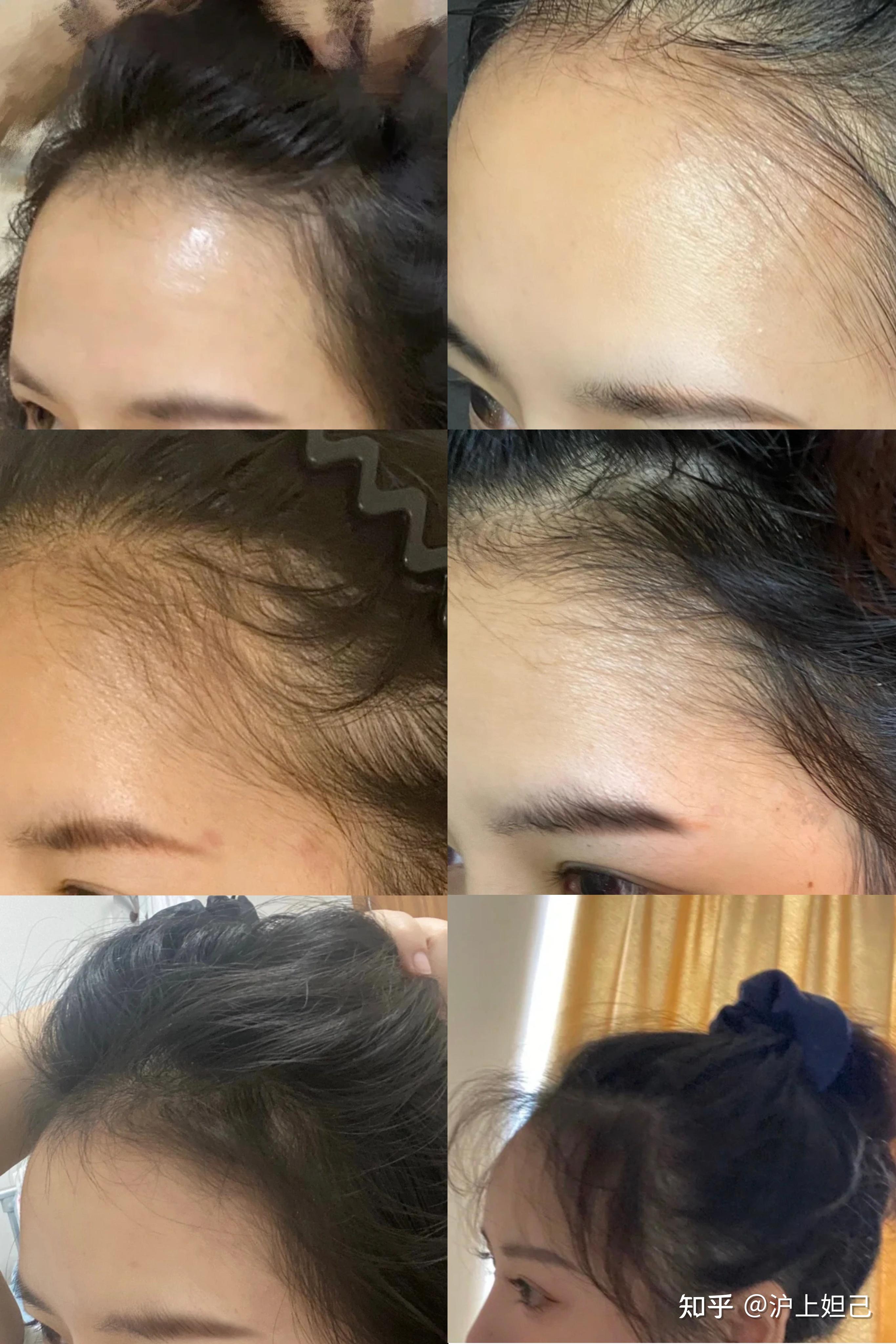 每次洗头都会掉头发,感觉自己发量有点少,怎么让头发变多? - 知乎