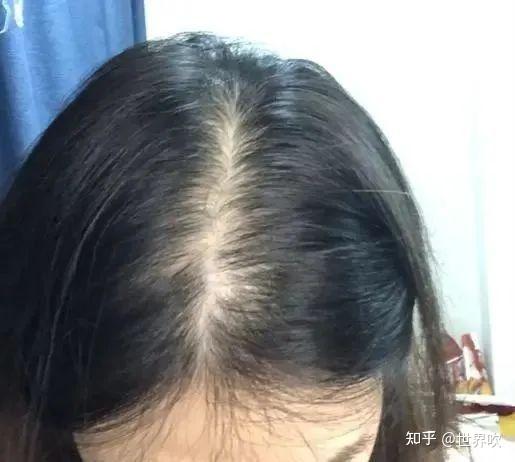 发缝终于回来了!养发一年成功get鞠婧祎同款发量! - 知乎