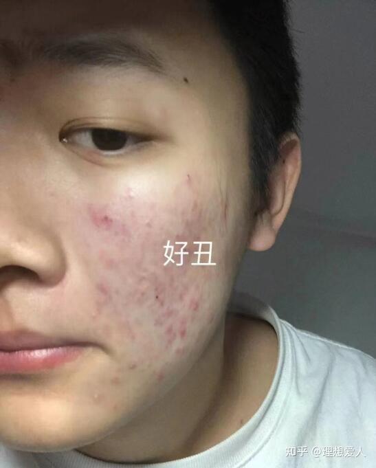 男生痘痘肌要怎么护肤痘印咋消