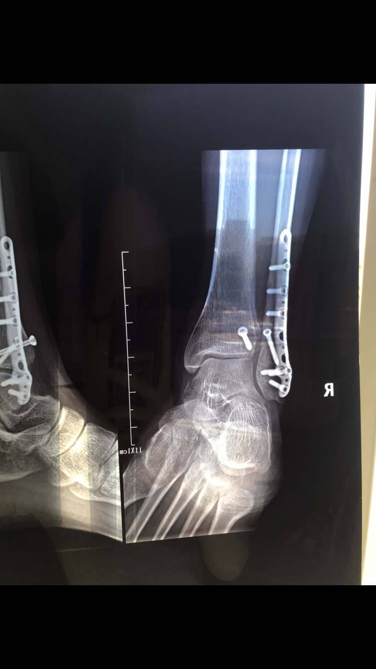 脚踝骨折近一年的恢复情况
