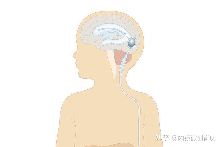 治疗脑积水选择造瘘还是选择分流 - 知乎