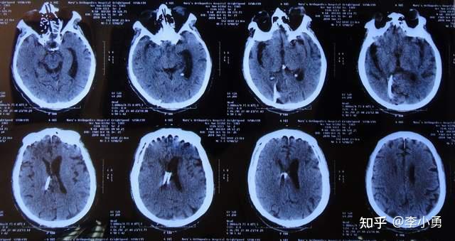 垂體瘤術後腦脊液漏,請北京專家再經鼻補漏後雙眼失明腦積水並顱內