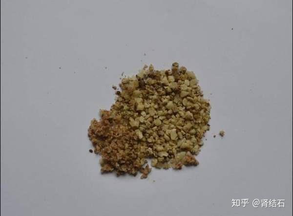 我们知道,现在最为常见的结石就是草酸钙结石,而形成草酸钙结石的根本