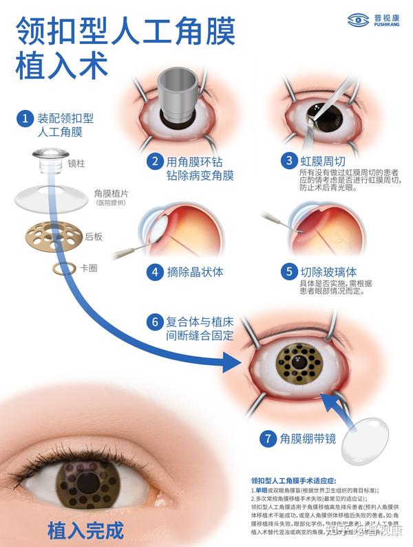 单眼角膜盲患者通过普视康领扣型人工角膜移植成功复明 - 知乎