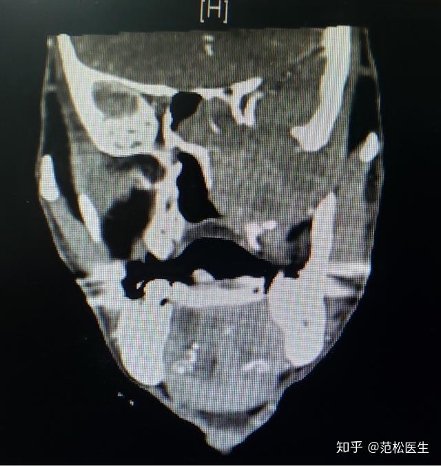 病例分享丨鼻咽癌放療誘導的左上頜顱底骨肉瘤