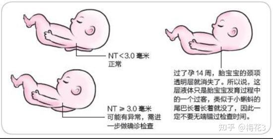 关于怀孕检查nt的一些事情 知乎