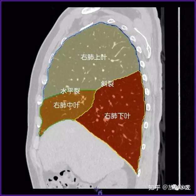 冠状位横断位左肺借斜裂成上,下两叶;右肺借斜裂和水平裂成上,中和下