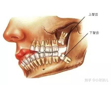 智齿冠周炎的危害及治疗方法 - 知乎