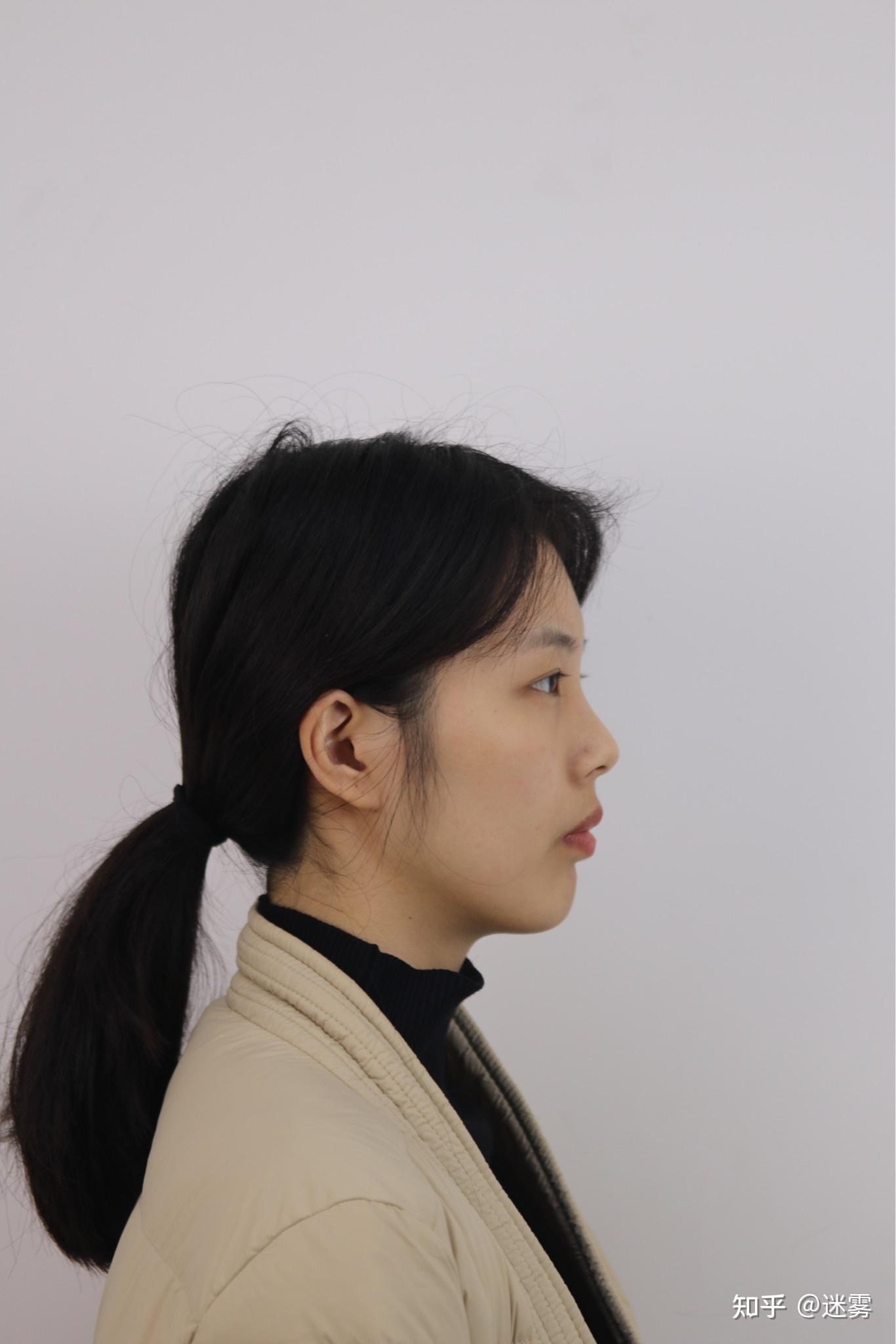 23岁想整牙害怕黑三角后遗症骨性深覆合到底值不值得有没有必要做矫正