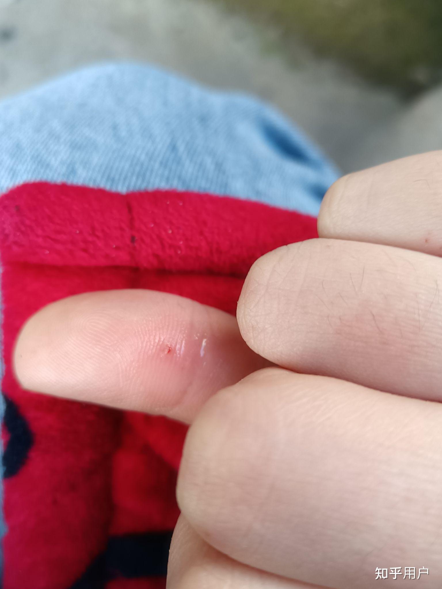 怎么弄出来手里扎进去的小刺?