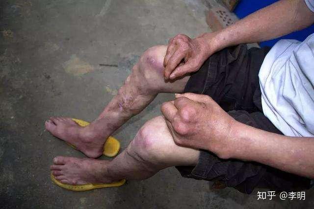 等疾病(4)饮用水污染的危害:常见的饮用水水质项目对人体健康的影响铅