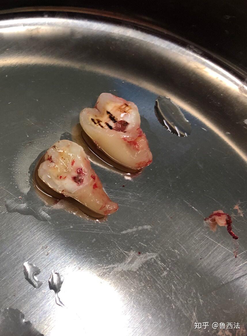 为什么智齿会往外面长呀? - 知乎