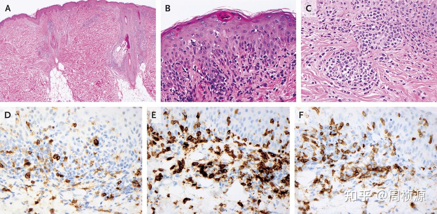 表皮和滤泡上皮见到角化细胞坏死(图3a).