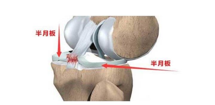 康复案例32——半月板3度损伤保守治疗