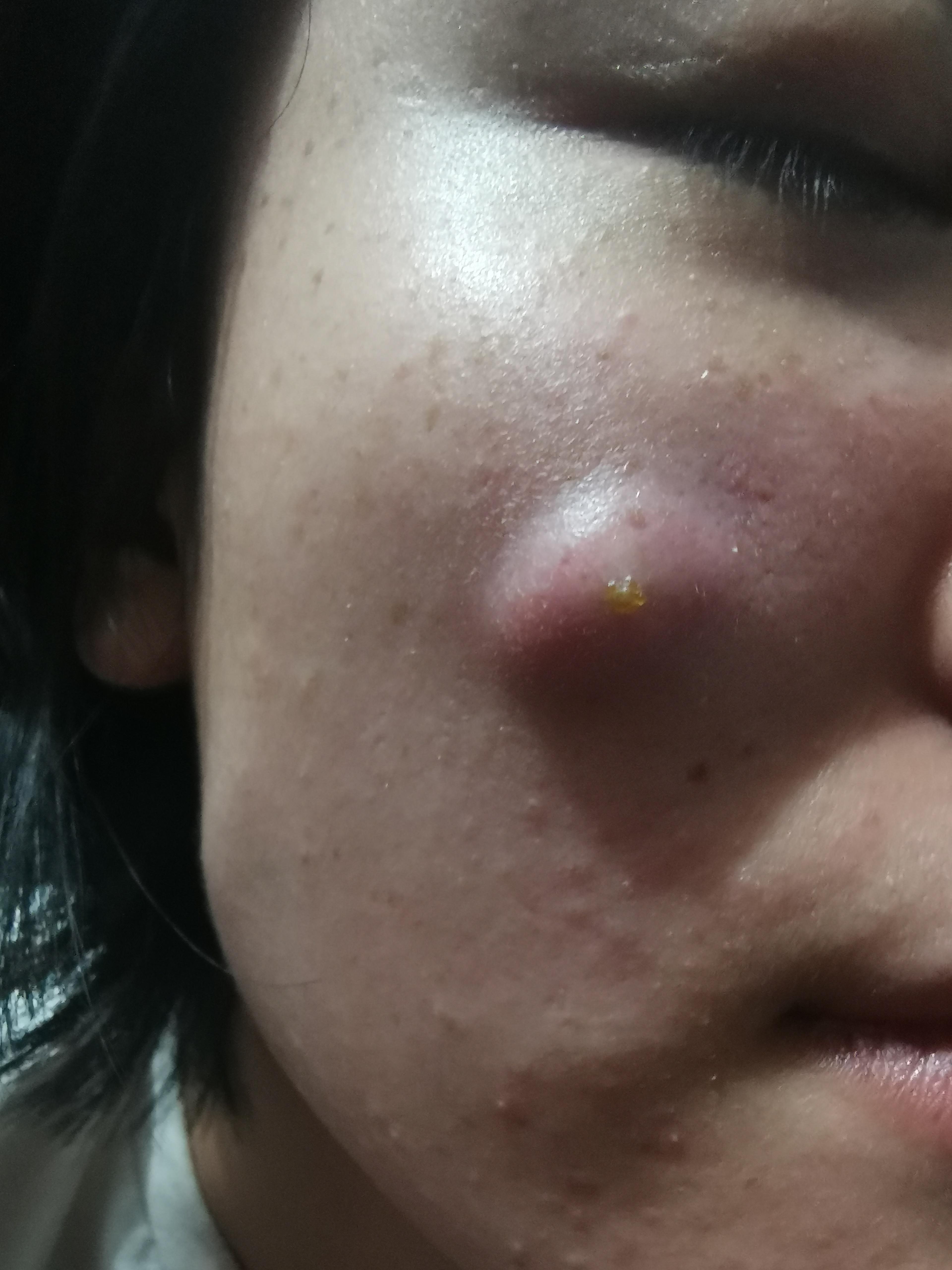 我在协和医院西院做过整容科的手术我高二的时候在脸上长了一个粉瘤