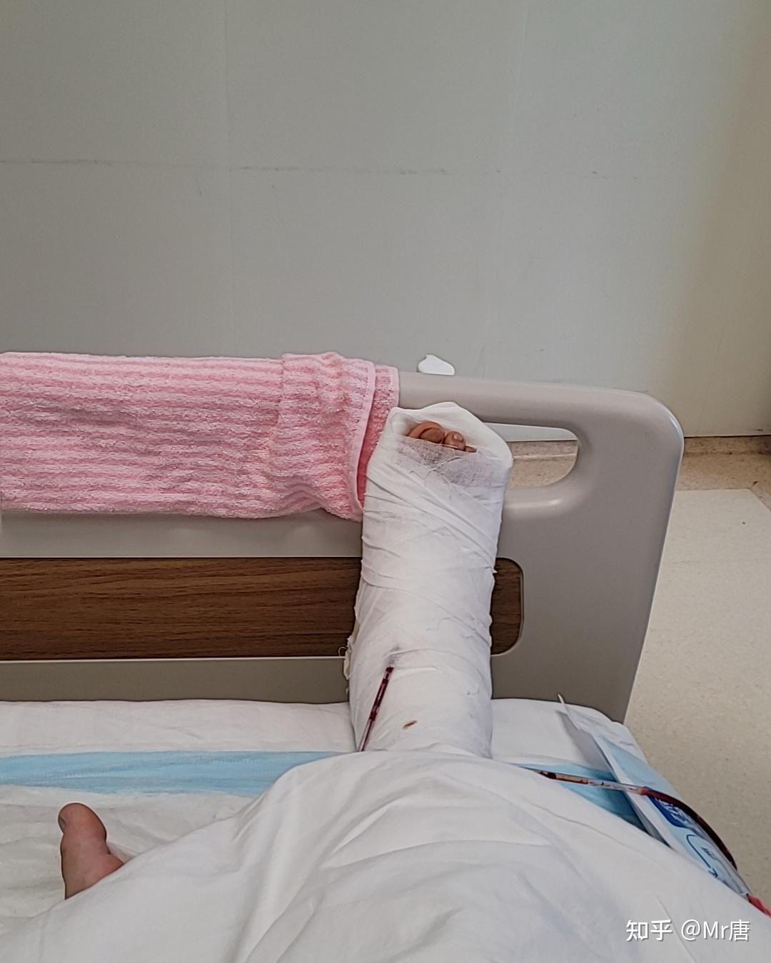 脚踝距腓前韧带断裂诊断治疗康复全过程