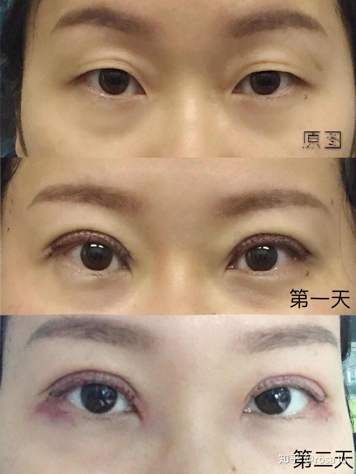 无痕全切双眼皮手术恢复情况分享简单粗暴全是照片