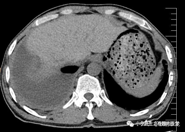 有趣病例游走的胸腔积液