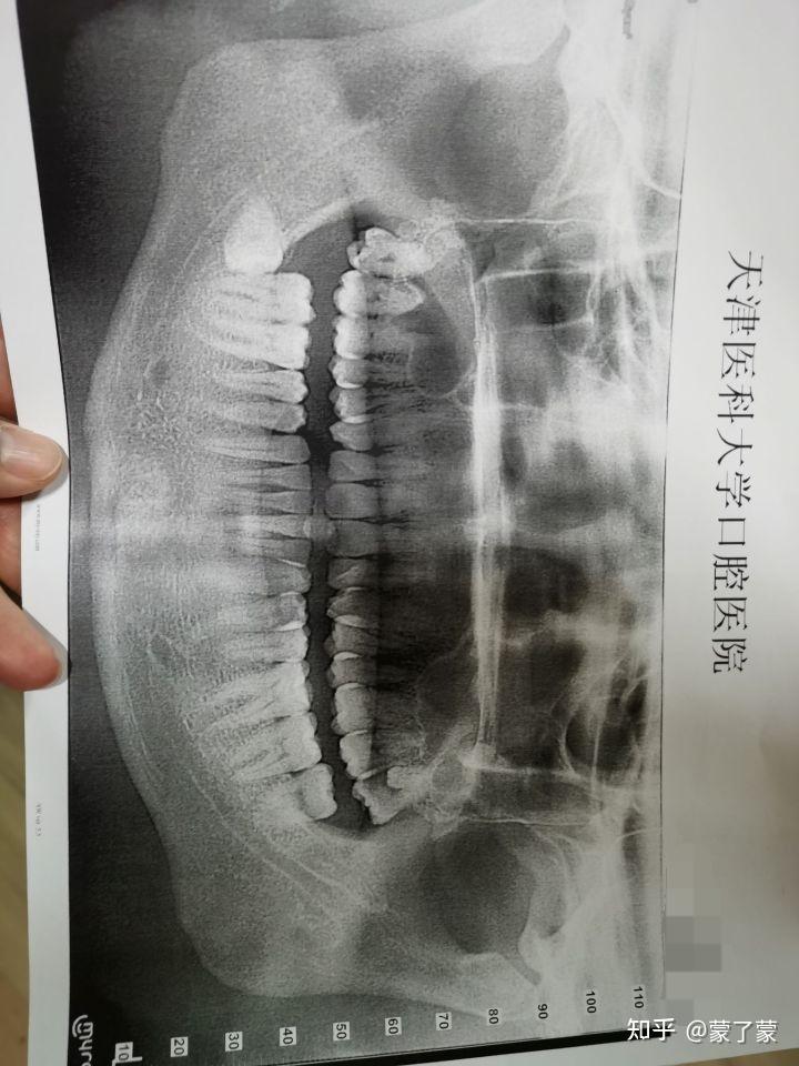結果到了我這裡經典了,先去照了x光片,齊活,智齒,阻生齒,還有傳說中的