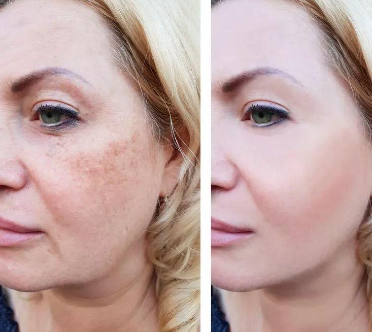 及额部皱纹,关节皱褶及妊娠纹;04,雀斑,颧骨母斑等色素性病变的治疗