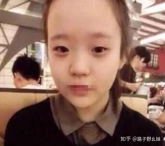 网红卵母细胞假体满天飞 脸没一处是真的 鼻头鼻尖一样高是整容后遗症 知乎