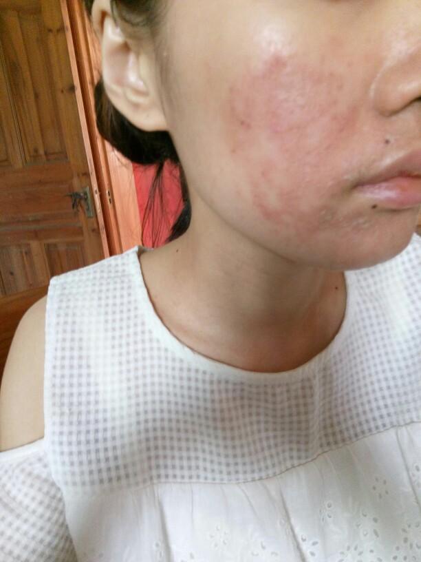 激素皮炎过敏肌肤用山茶油真的好了