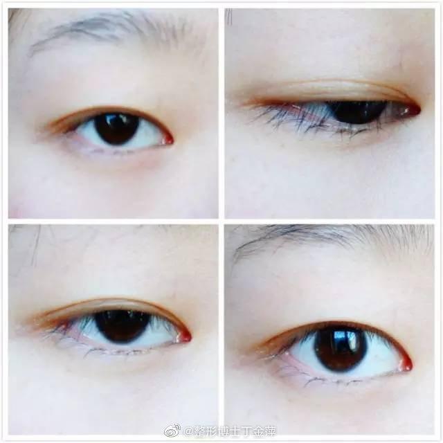 做完双眼皮手术以后为什么会变成内双?