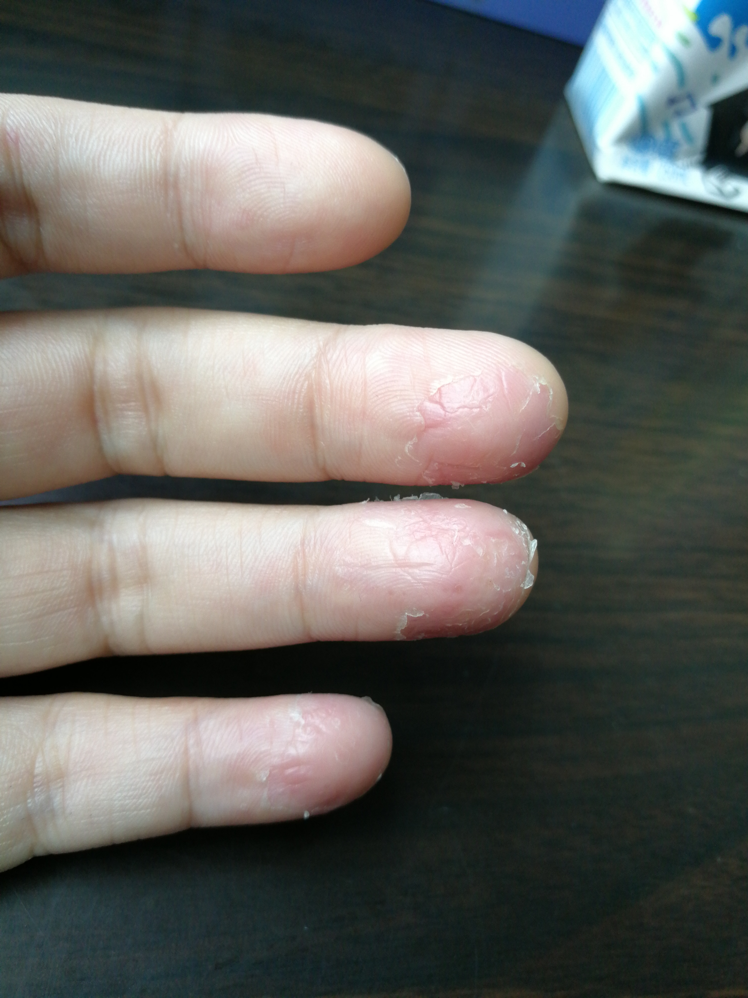 手指脱皮起泡
