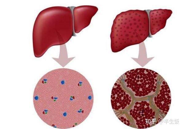 什麼叫早期肝硬化逆轉幾率有多大