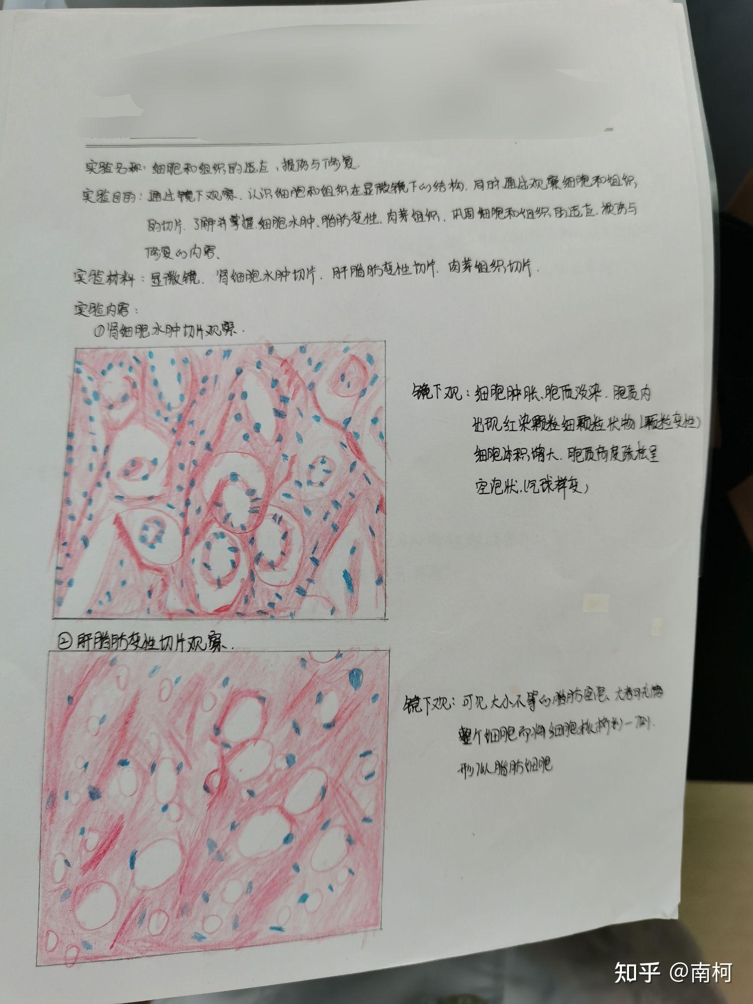 脾凝固性坏死手绘图图片