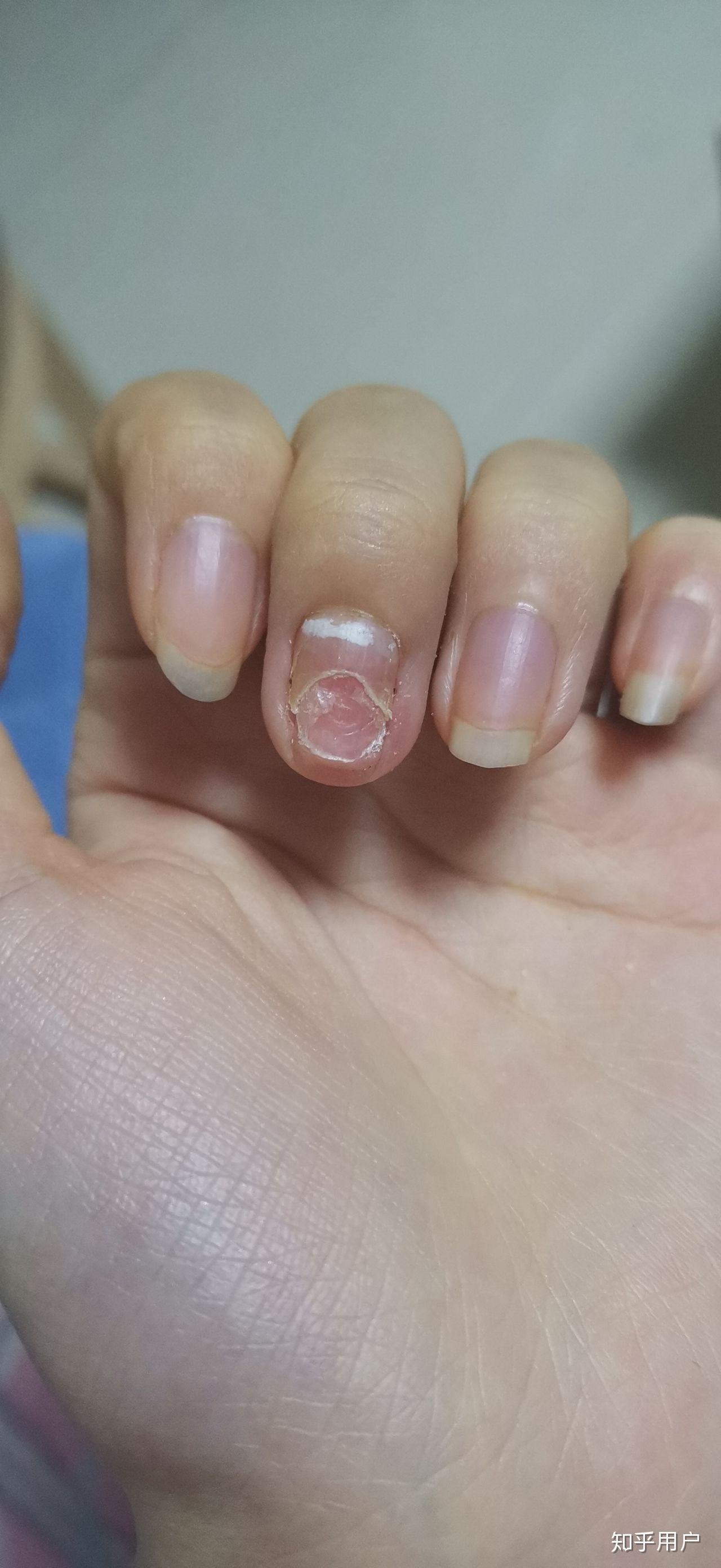 甲分离有六七年了从一个指甲慢慢发现到6个并且脚趾甲也开始空了每年4