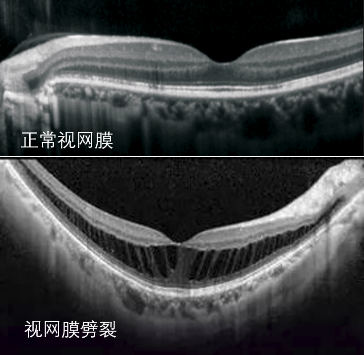 视网膜劈裂:视网膜脱离是眼球里面的水,通过视网膜裂孔流入视网膜下