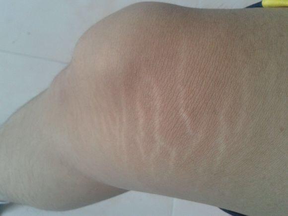 男人有妊娠纹是怎样一种体验可以去除和修复吗