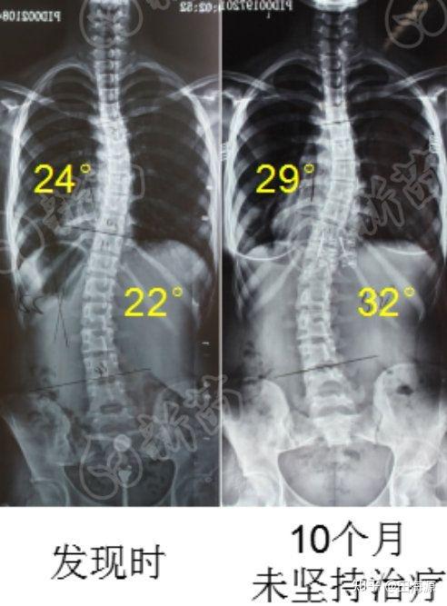 10岁以内——脊柱侧弯黄金期,10