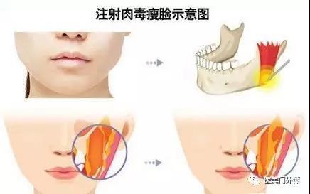 涨知识 肉毒素的干货篇 知乎