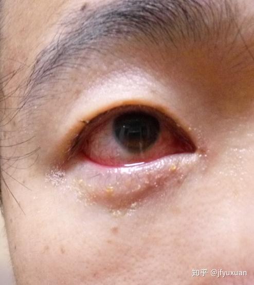 经方退天行赤眼