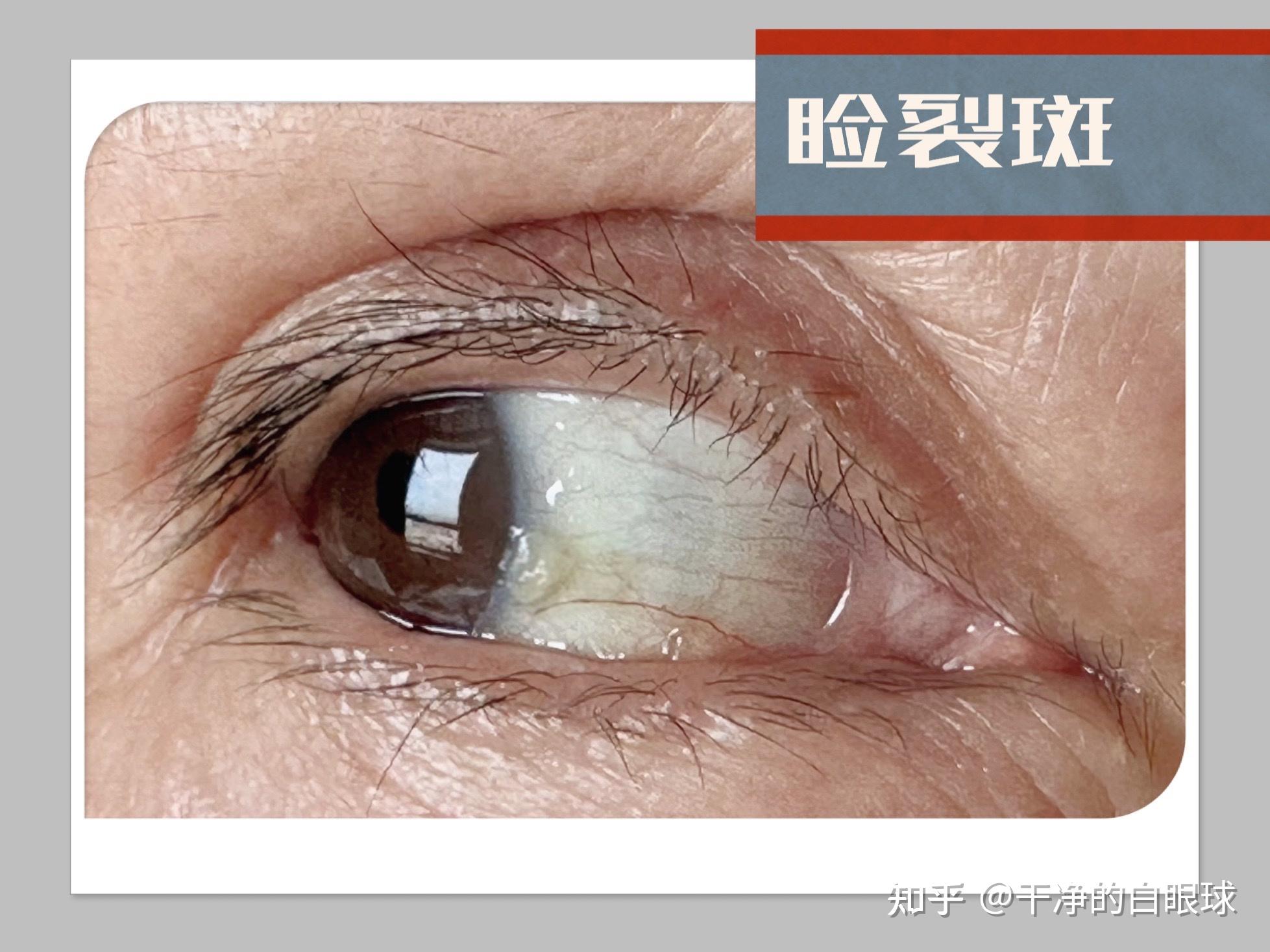 横浜相鉄ビル眼科医院で瞼裂斑（けんれつはん）の手術を受けた患者さんの写真