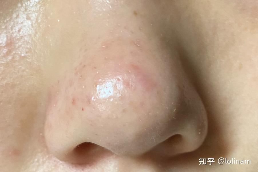 我的鼻子因为挤黑头成这个样子了怎么恢复啊啊啊啊啊啊啊