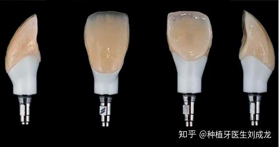 即刻种植即刻修复拔牙后即刻植入种植体可能是延期植入的可行替代方案