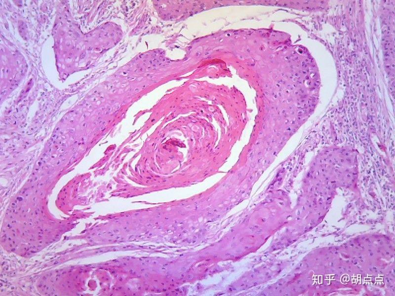 高分化鳞状细胞癌低分化鳞状细胞癌直肠腺癌平滑肌瘤平滑肌肉瘤高低倍