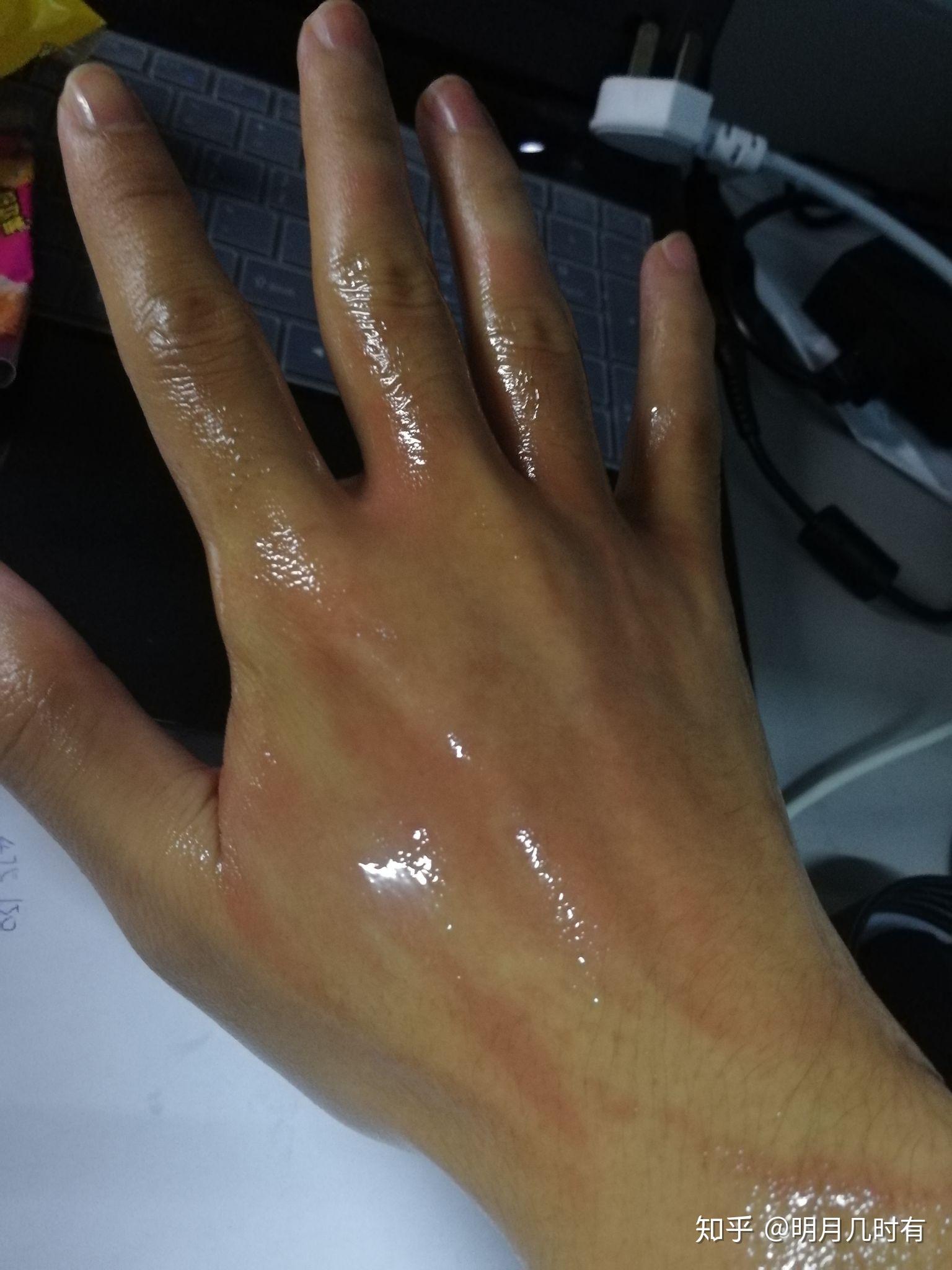 手烫伤了怎么处理?