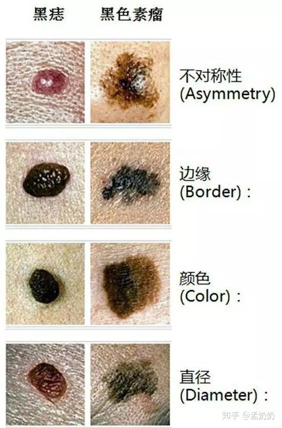 痣周围小卫星痣图片图片