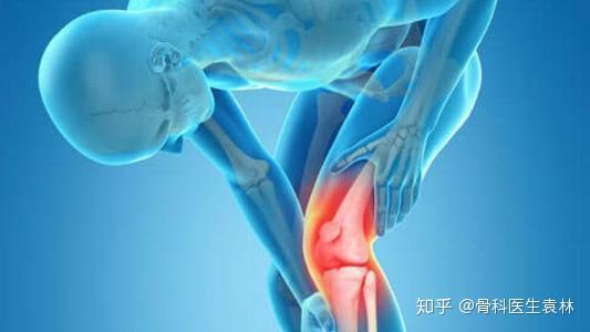 膝关节软骨损伤怎么办 膝关节软骨损伤康复治疗方法 知乎
