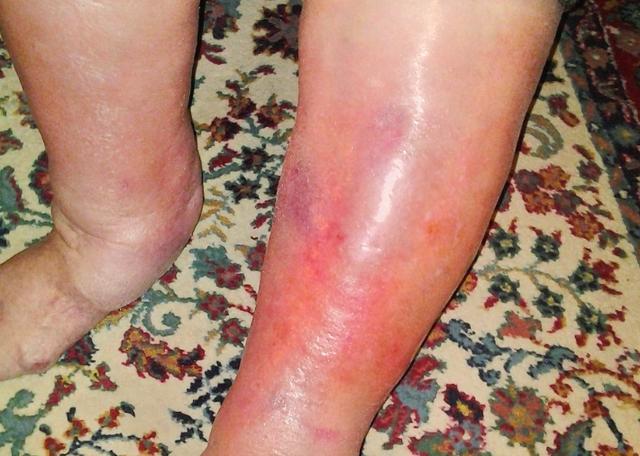 期,在患有丹毒后,患者首先会出现突然的发热,寒战,恶心,头痛等症状