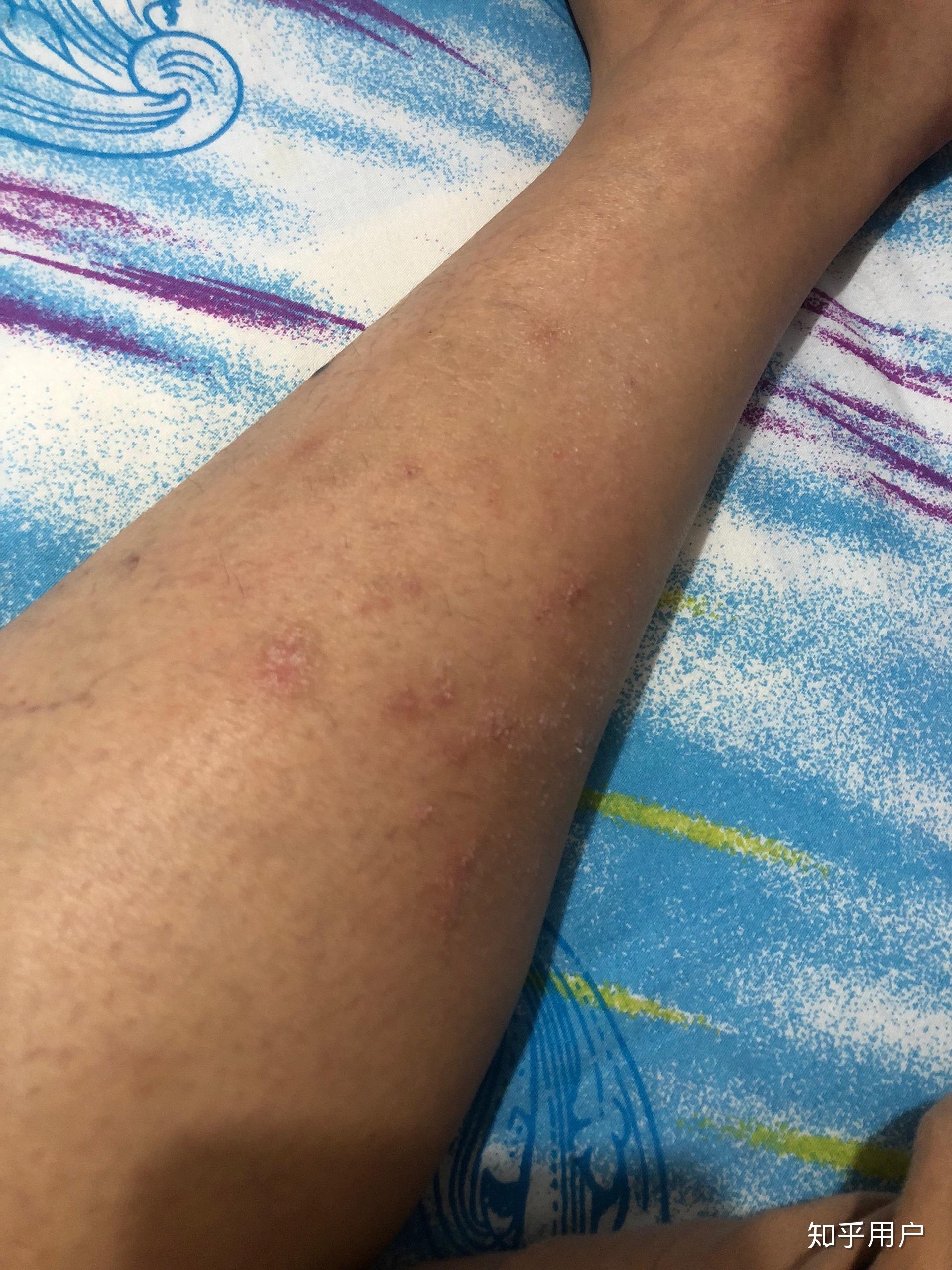 大腿内侧起一片红疹子，刚起的时候很痒，好了之后还起_皮肤科_邻医网