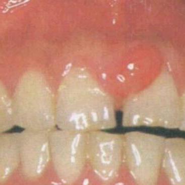 牙龈增生息肉图片