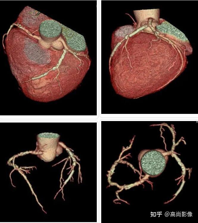 健康科普心臟cta西安高尚醫學影像