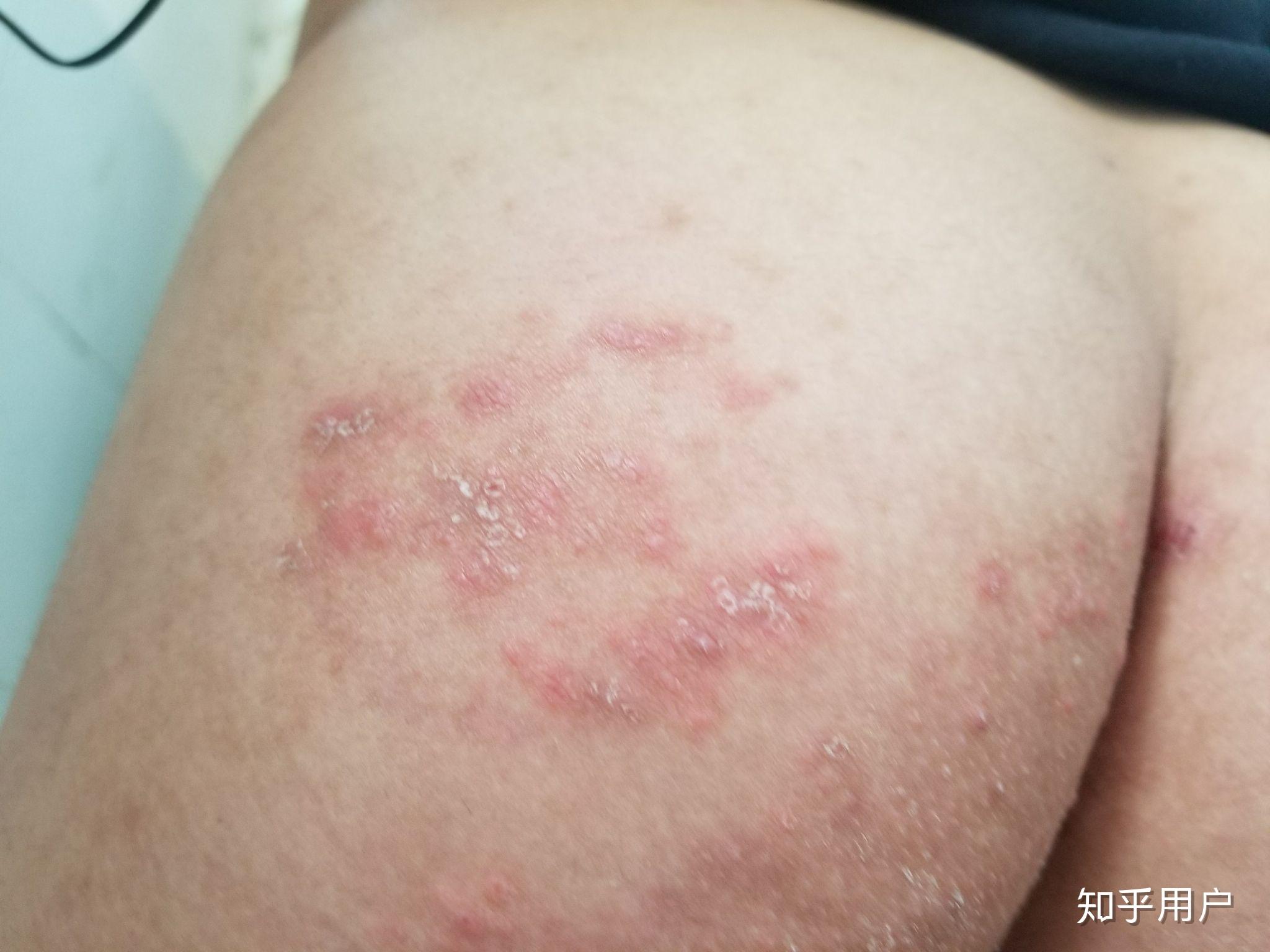请问这是湿疹还是股藓有图慎入