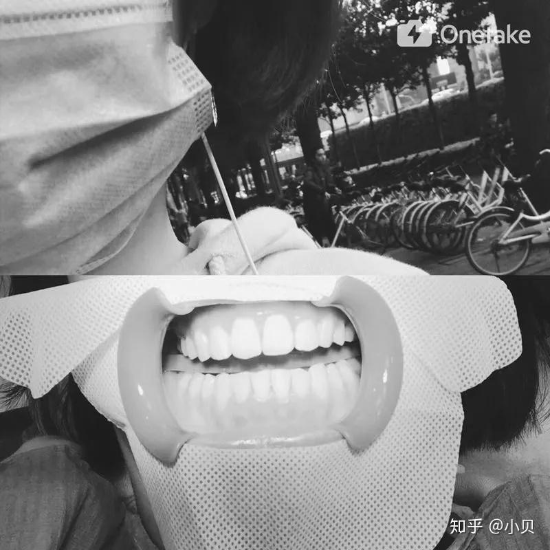 突嘴怎么自己矫正 v2-03773cb450296e0af074a78cf37f089c_r.jpg