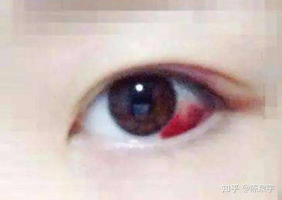 小宝儿眼白出现大块血斑——早上的突发小事件 - 知乎